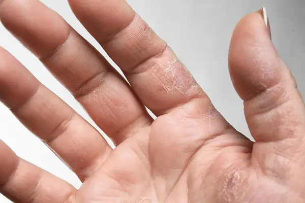 Zbliżenie na dłoń na której widnieją liczne pęknięcia. 